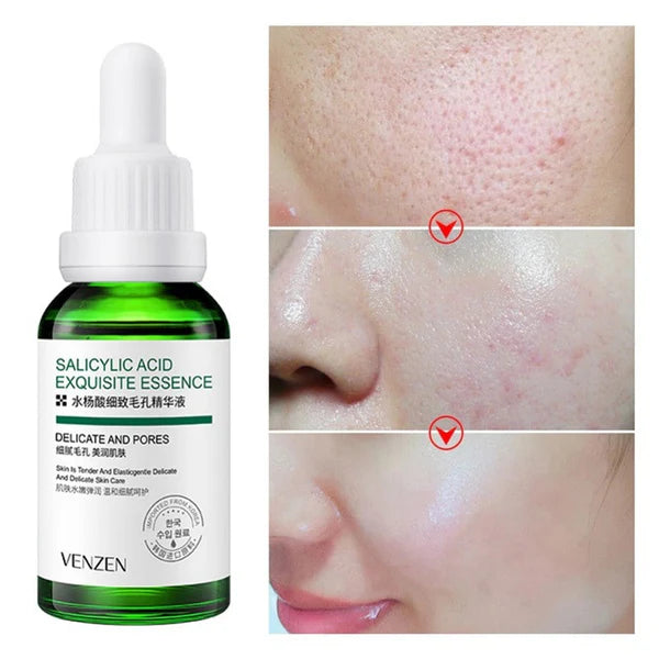 Combo Acido Salicílico Bioaqua x 3 Anti-Acné